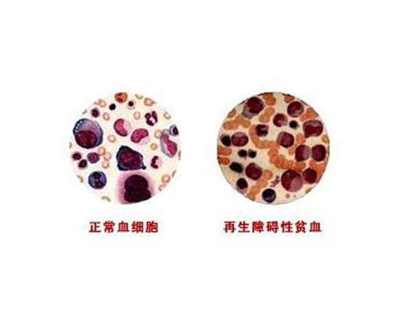 再生障碍性贫血诊断：不能仅看全血细胞减少，这些关键信息也会影响判断和治疗
