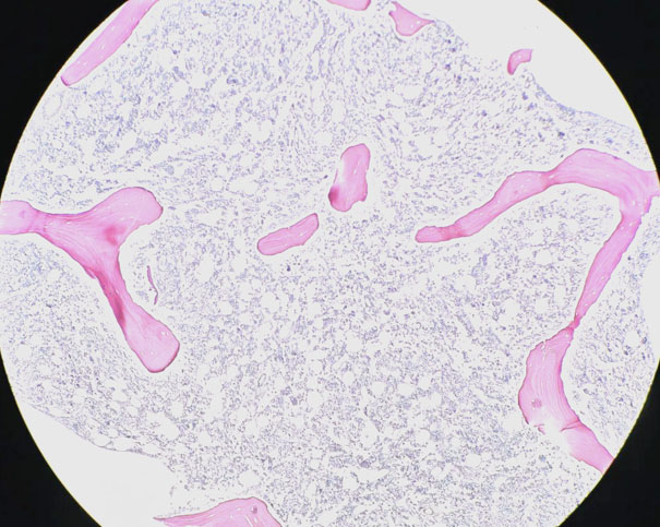 解析MDS五种分型:血象骨髓表现差异与治疗