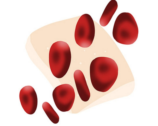 面对血小板减少的血常规结果:如何抽丝剥茧寻病因?