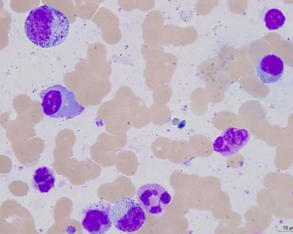 现代医学如何应对浆细胞疾病:解读症状与探索治疗新策略