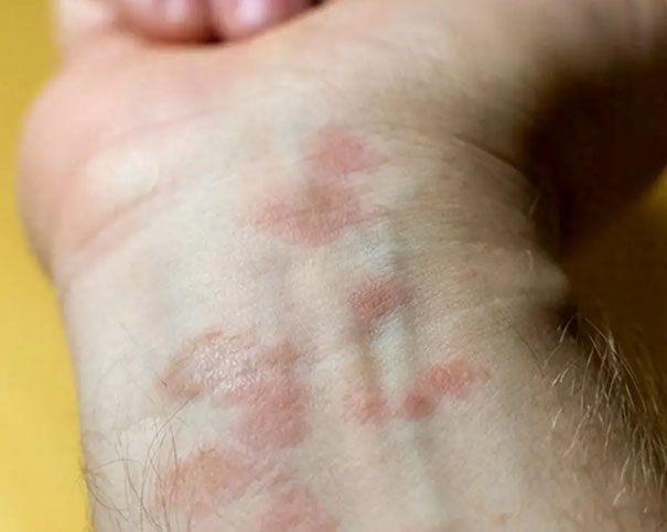 从“蝴蝶斑”到多器官损伤：认识红斑狼疮的免疫系统攻击之路